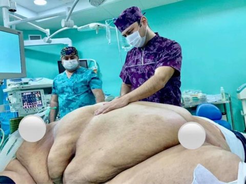 Azərbaycanın ən nəhəng adamını əməliyyat edən həkim: “500-dən çox insanın mədəsini kiçiltmişik”