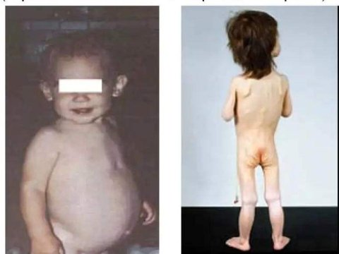 Pediatrdan təhlükəli xəstəliklə bağlı XƏBƏRDARLIQ: “Bəzən diaqnoz vaxtında qoyulmur”