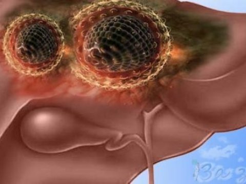 Həyatları söndürən “səssiz qatil” – bu xəstəlikdən necə qorunaq?