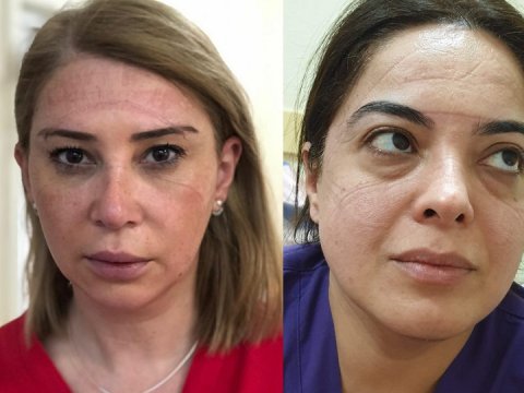 Günümüzün qəhrəmanları: Virusla mübarizə aparan həkimlər - “İnsanlarımıza deyin ki...” - FOTOLAR