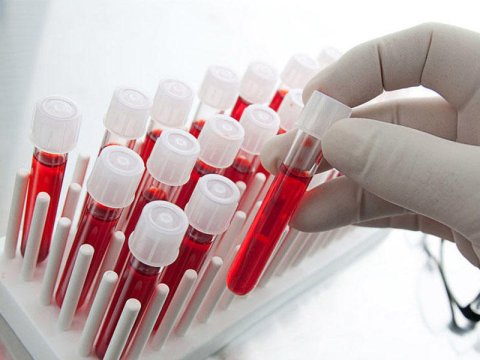 Ölkədə hər 100 min nəfərdən 433-ü anemiyalıdır