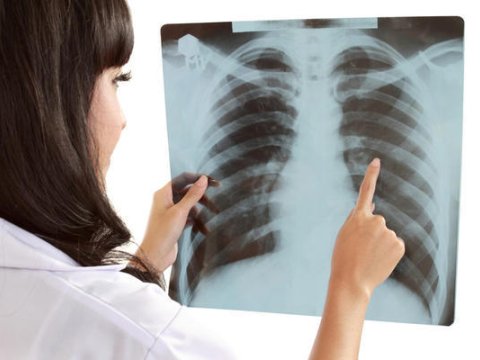 Dünyada hər dəqiqə vərəmdən 2 nəfər ölür