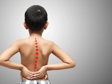 Bu yaşlarda uşaqlarda skolioz yarana bilər