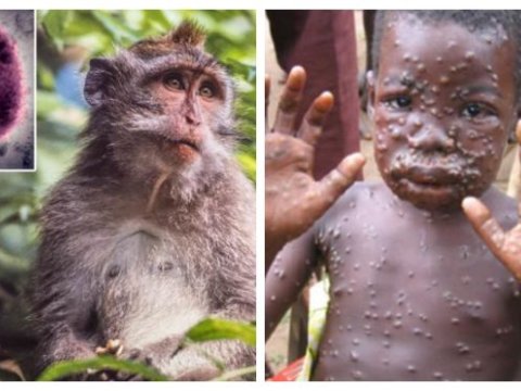 “Meymun çiçəyi” bizim üçün təhlükəlidirmi?