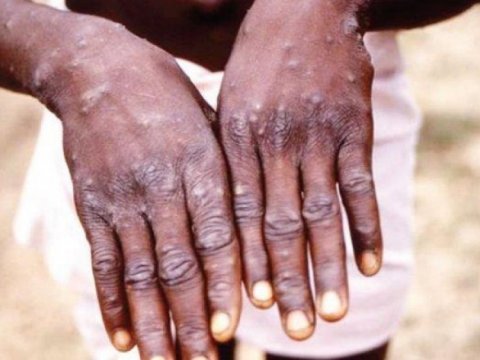 İndiyədək necə nəfərdən meymunçiçəyi testi götürülüb? - RƏSMİ