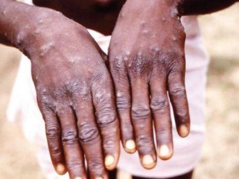 Meymunçiçəyinə yoluxma sayı 50 mini keçdi