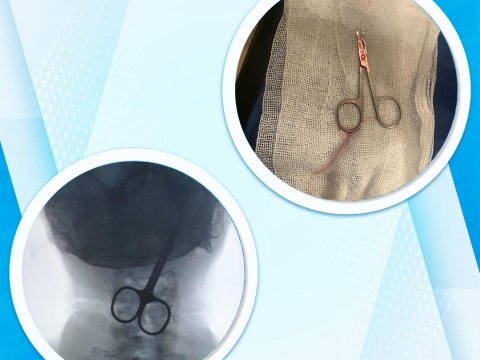 Bakı sakini qayçı udub - FOTO