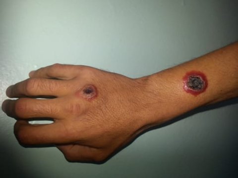 Bərdədə qarayaraya yoluxanların vəziyyəti necədir? - AÇIQLAMA