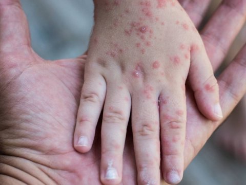 Dağıstanda qızılcaya kütləvi YOLUXMA