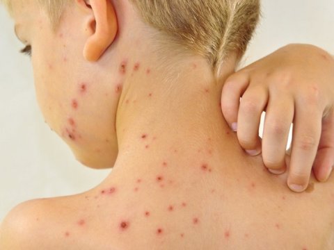 Azərbaycanda qızılca ilə bağlı narahatlıq yoxdur - ÜST