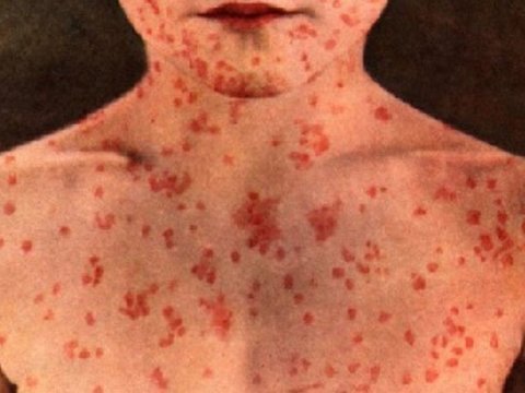 Ermənistanda qızılcaya yoluxanların sayı artır