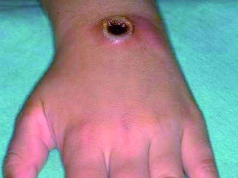 Tuvada 4 nəfər Sibir xorasına yoluxdu