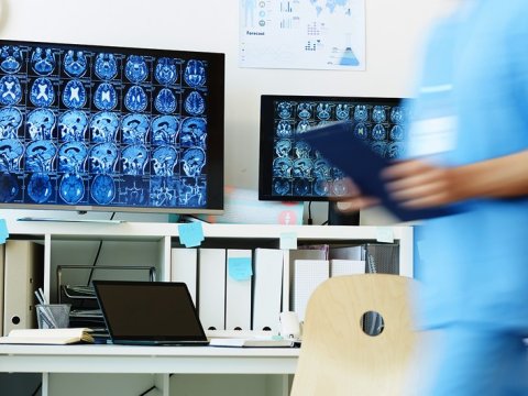 Beyin xərçənginin müalicəsi üçün effektiv üsul