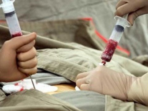Sümük iliyi transplantasiyası cərrahi müdaxilə olmadan həyata keçiriləcək