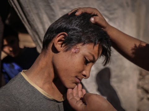 Bu il 31 ölkədə vəba epidemiyası qeydə alınıb - ÜST