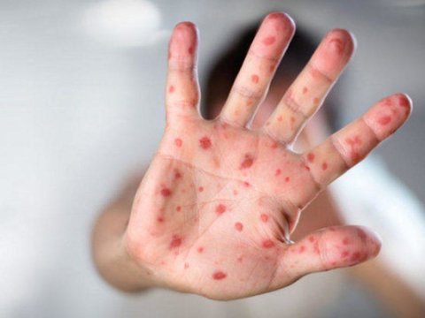 Nazirlik Şəkidə qızılcaya kütləvi yoluxma ilə bağlı məlumat yaydı