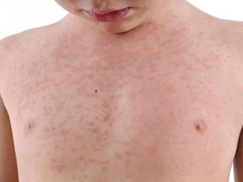 Ermənistanda qızılcaya yoluxanların 70 faizi azyaşlıdır