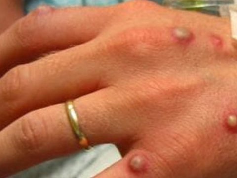 Bu ölkədə “meymunçiçəyi” virusundan ölüm qeydə alındı