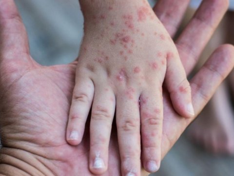 Qızılcaya yoluxan azyaşlı ÖLDÜ