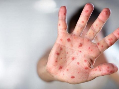 Daha bir rayonda qızılca aşkarlandı: Universitet tələbləri arasında YOLUXMA