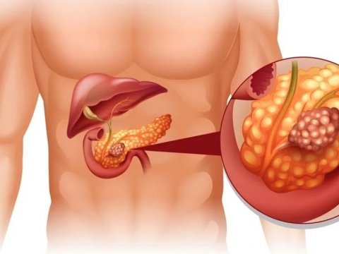 Mədəaltı vəzi xərçəngini 92 faiz dəqiqliklə aşkarlayan test
