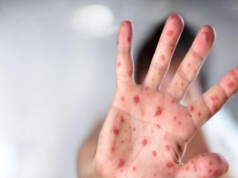 Bakıda qızılcaya görə heç bir məktəb bağlanmayıb - RƏSMİ