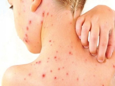 Deputat qızılcaya yoluxmanın artmasının səbəbini AÇIQLADI