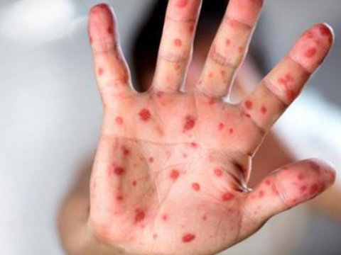 Bakıda şagird qızılcadan ÖLÜB