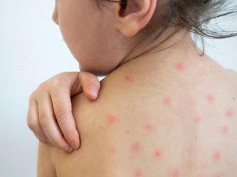 TƏBİB qızılcadan öldüyü deyilən şagirdlə bağlı məlumat YAYDI