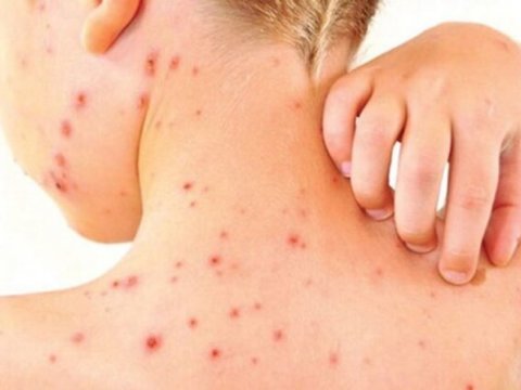 TƏBİB qızılcaya görə hərəkətə keçdi - Xəstəxanalar hazır vəziyyətə gətirildi