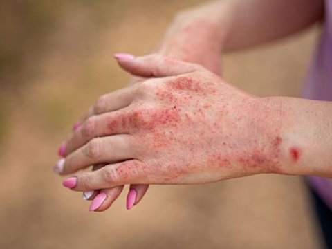 Qızılcaya yoluxma artır - TƏBİB-dən həyəcan təbili