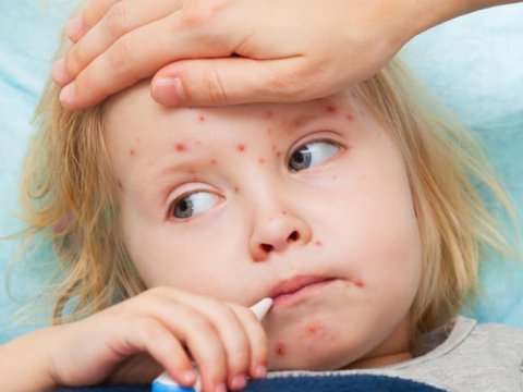 Daha bir məktəbdə qızılca: 9 şagird, 1 müəllim...