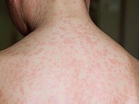 Daha bir uşaq qızılcadan ÖLDÜ