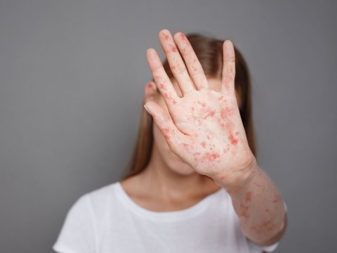 Qızılcadan ölən məktəbli ilə bağlı AÇIQLAMA 