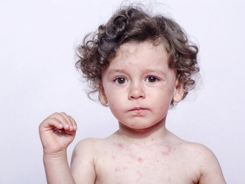 Oğuzda 11 nəfər qızılcaya YOLUXDU