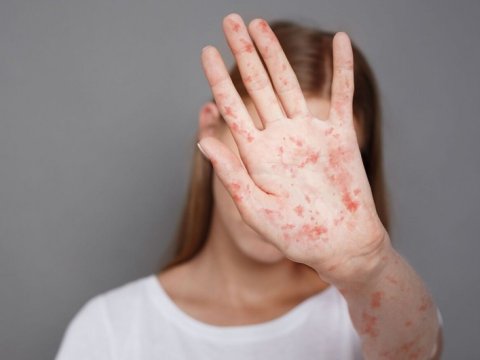 Sığınacaqda 40-a yaxın uşaq qızılcaya YOLUXDU