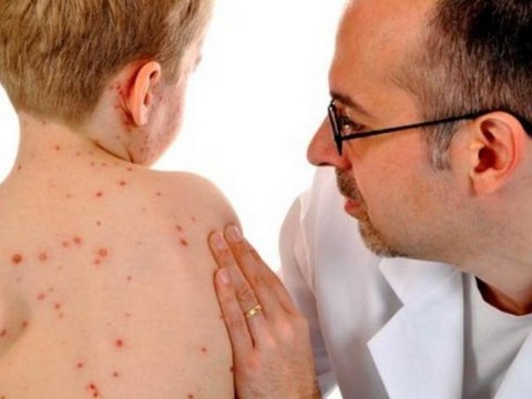 Qızılcadan qorunmağın yolları AÇIQLANDI