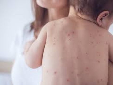 Qızılca zamanı hər an ağırlaşmalar baş verə bilər - Epidemioloq