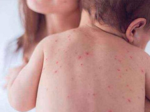 Ermənistanda qızılca tüğyan edir - Yoluxma ARTDI