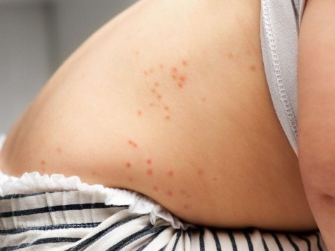 Daha bir uşaq qızılcadan öldü: 1-ci sinifdə oxuyurdu... - FOTO