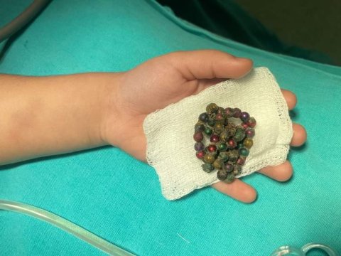 Azərbaycanda dəhşət: 4 yaşlı uşaq 53 ədəd maqnit uddu - FOTO