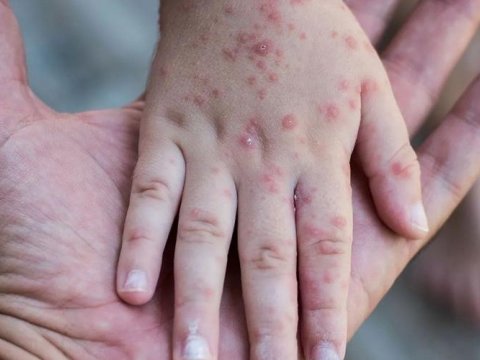 Səhiyyə Nazirliyindən qızılca ilə bağlı ÇAĞIRIŞ