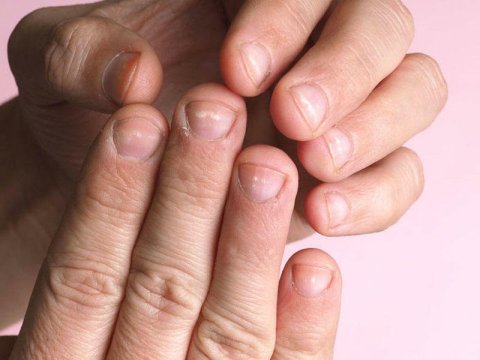 Dırnaqların rənginin dəyişməsi xəstəlik əlamətidir