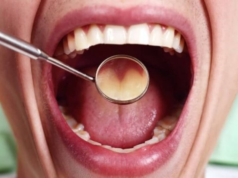 Boğazda xroniki ağrı ağız boşluğu xərçənginin əlamətidir