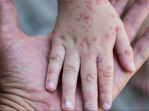 Qızılcanın ilkin əlamətləri - Necə müalicə olunmaq lazımdır?