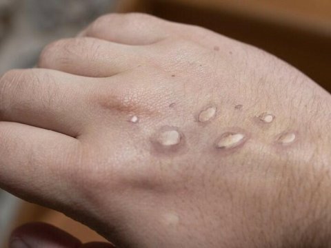 Meymunçiçəyi virusuna iki yoluxma qeydə alındı