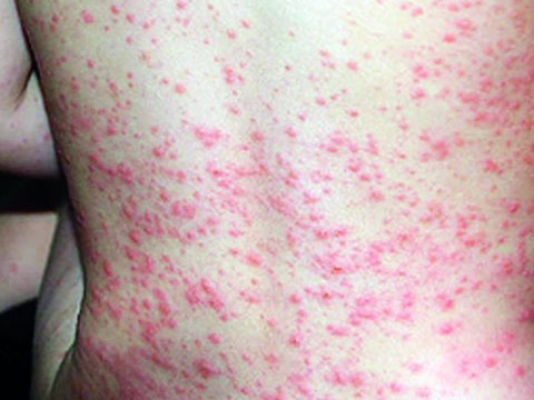 Uşaqlar arasında daha bir virus yayılıb - Qızılcaya bənzəyir...