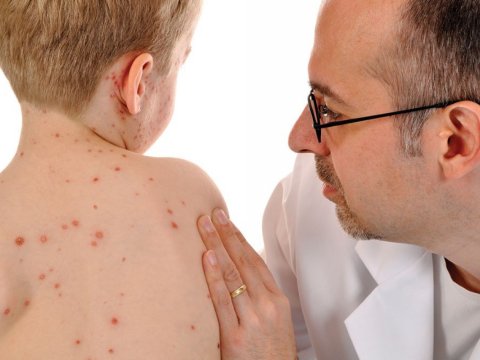 Azərbaycanda 8 min nəfərdə qızılca aşkarlanıb