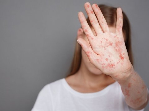 Ölkəmizdə qızılca təhlükəsi sovuşur?