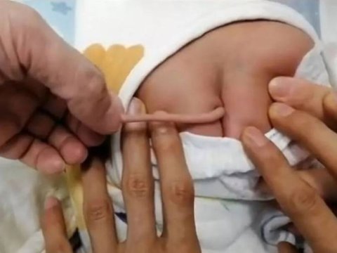 Quyruqlu uşaq doğuldu - Nadir hadisə